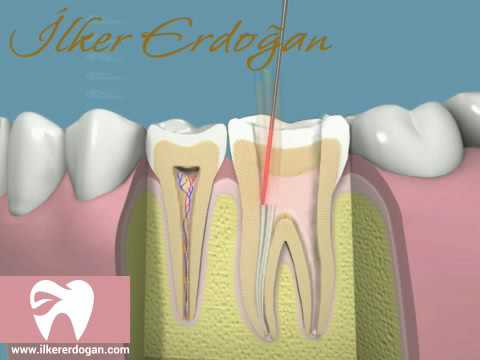 RCT Manual with Crown Movie