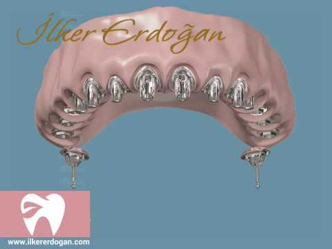 Upper Bridge with 14 Implants Movie