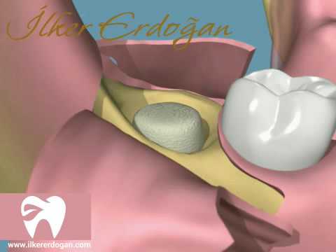 Wisdom Tooth Removal