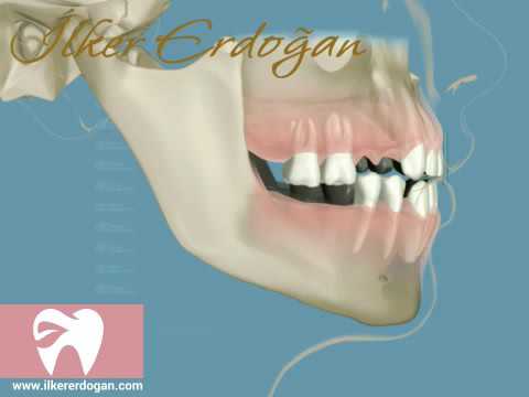 Anterior Teeth Splaying Movie