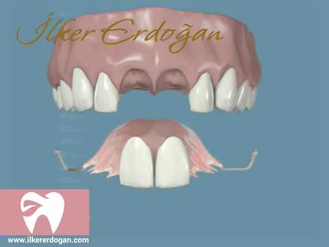 Complete Anterior Implant Procedure