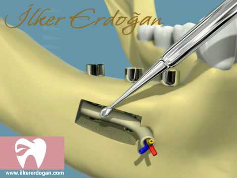 Mandibular Post Nerve Lateralization Movie