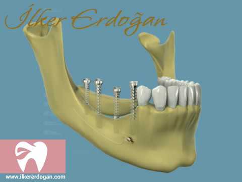 Mandibular Post Onlay Graft with Implant Placement Movie