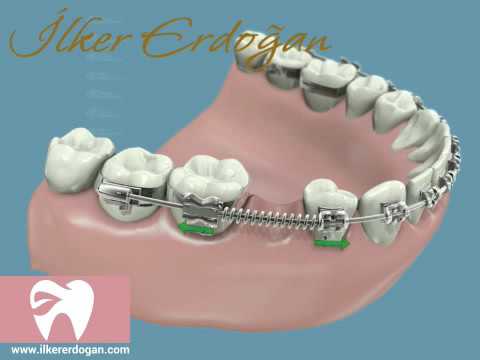 Molar up righting with Implant Movie