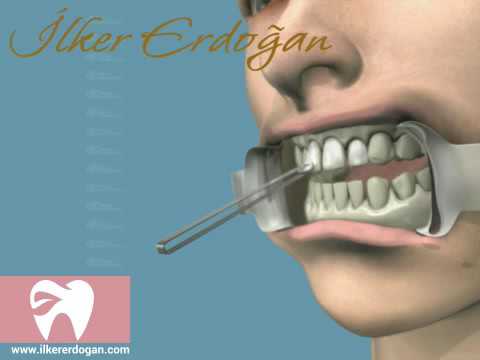 Teeth Photobleaching