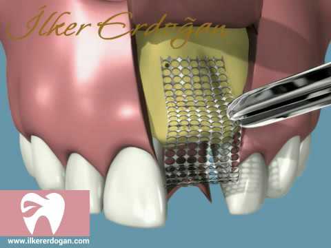 Single Tooth Graft Movie